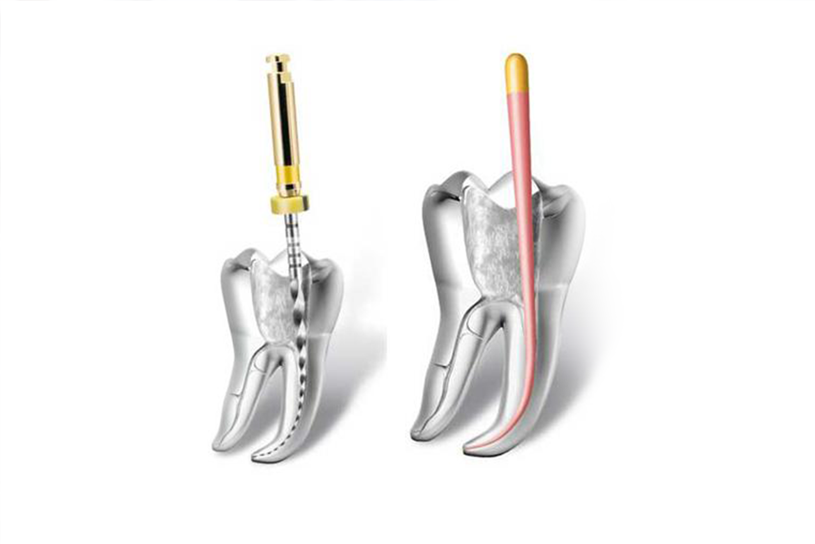 Endodoncia Motorizada + Reconstrucción Post Endo