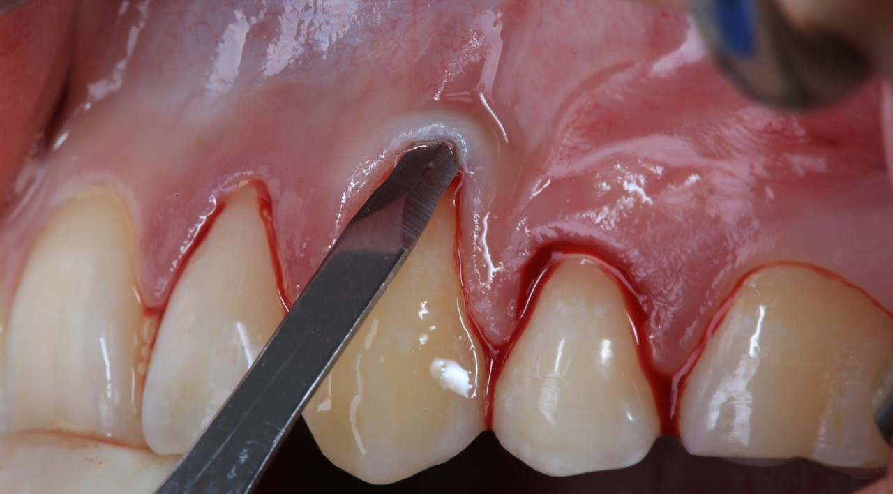 Cirugía Mucogingival (Periodontal y Peri-implantar)