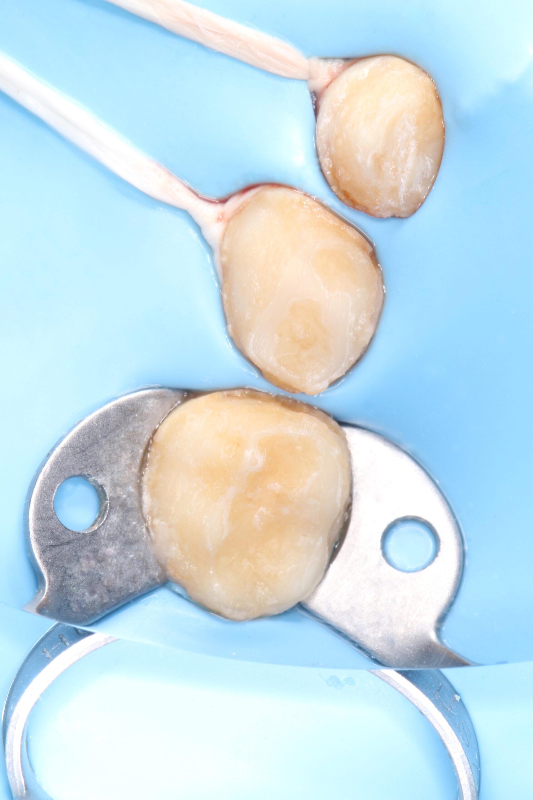 CoronHadas !! – Rehabilitación Biomimética Integral Antero-Posterior